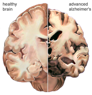 Alzheimer's Disease affects the brain.