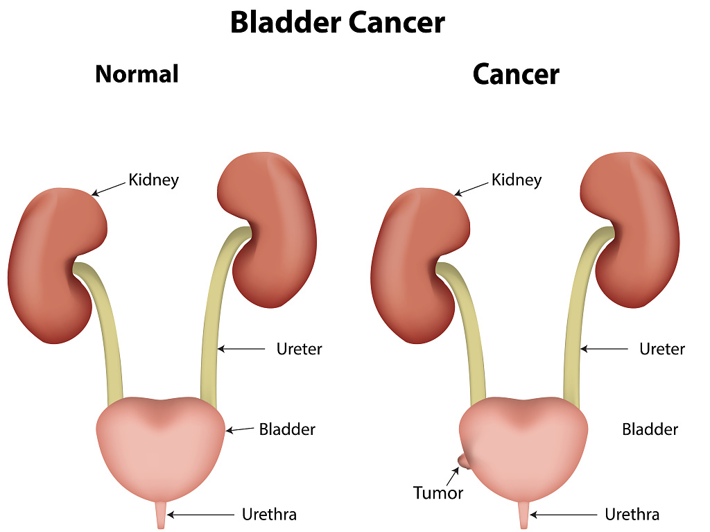 Bladder Cancer.