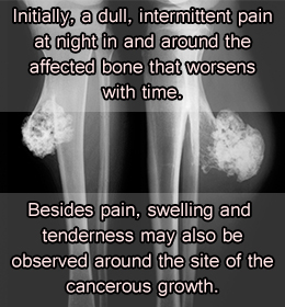 Bone cancer symptoms