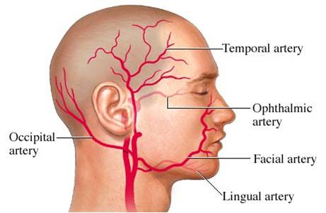 Temporal headache.